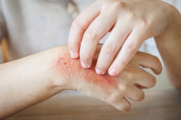 Is White Mold Dangerous with Allergies