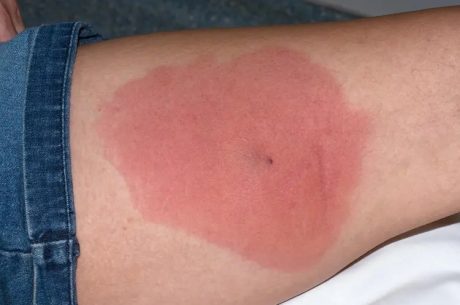 Understanding MRSA: Protection and Prevention in West Los Angeles & Santa Monica