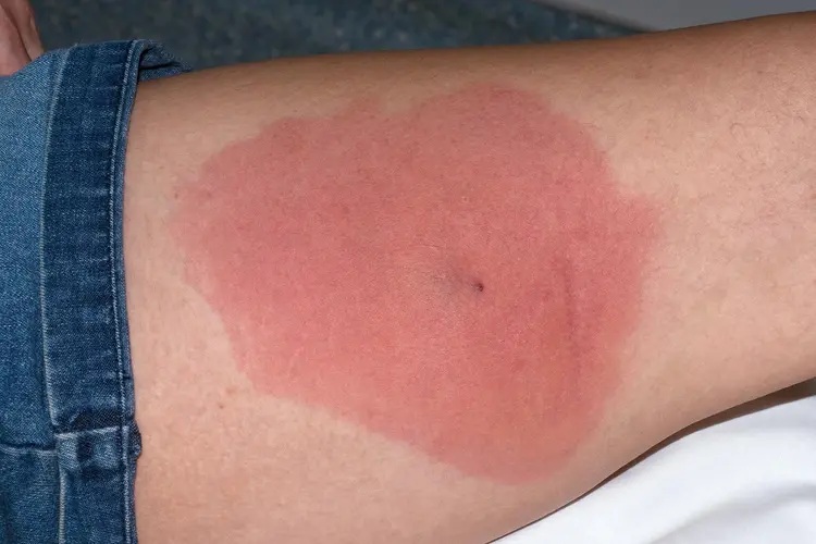 Understanding MRSA: Protection and Prevention in West Los Angeles & Santa Monica